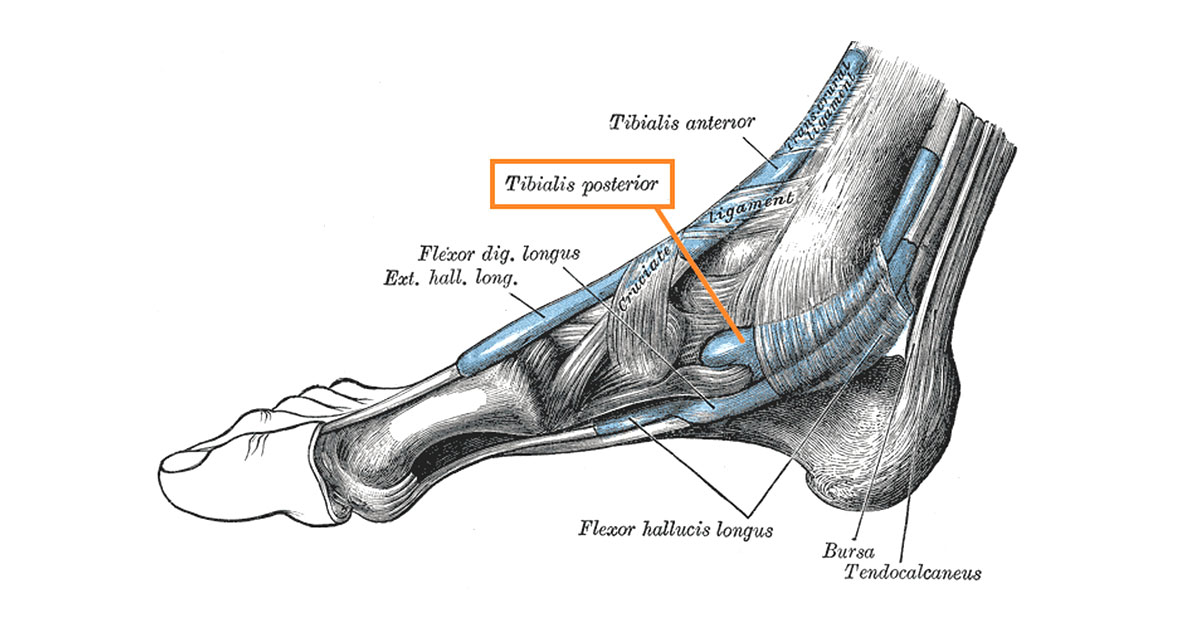 Posterior tibial tendon dysfunction is a common condition resulting from trauma or overuse injury to the tendon of the tibilais posterior muscle in the lower leg.
