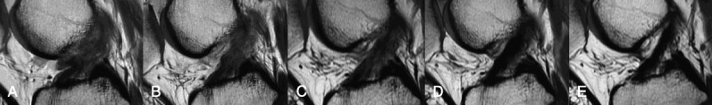 MRI pictures demonstrating ACL healing on MRI scan - Brisbane physiotherapist