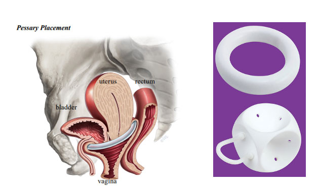 Treatemnt for Pelvic Organ Prolapse in Brisbane