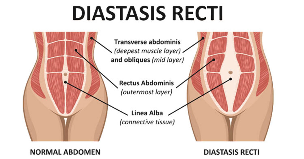 Abdominal muscle separation (Diastasis of the Rectus Abdominal Muscle, DRAM) after having a baby can be very common in post-partum women.  