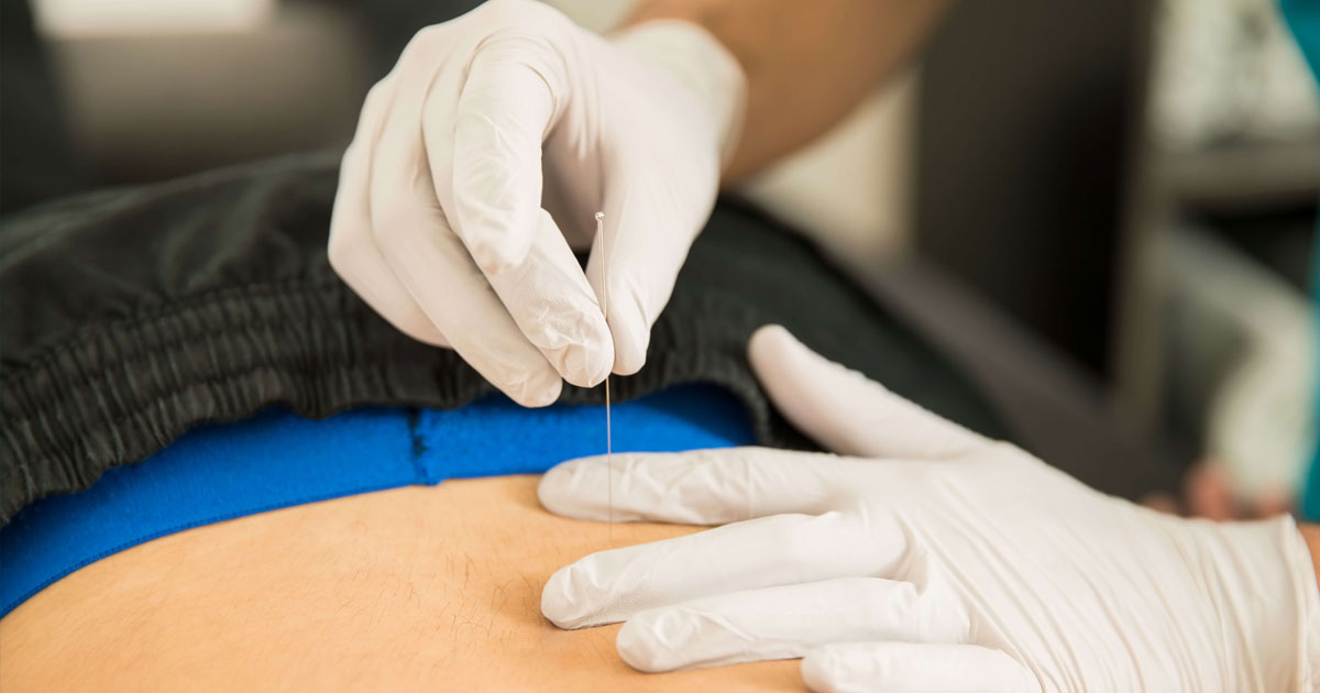 Musculoskeletal Physiotherapist Michael Ingle has advanced training and many years of experience in the use of dry needling. Read on for an overview of what dry needling is, and how it is used in physiotherapy. 
